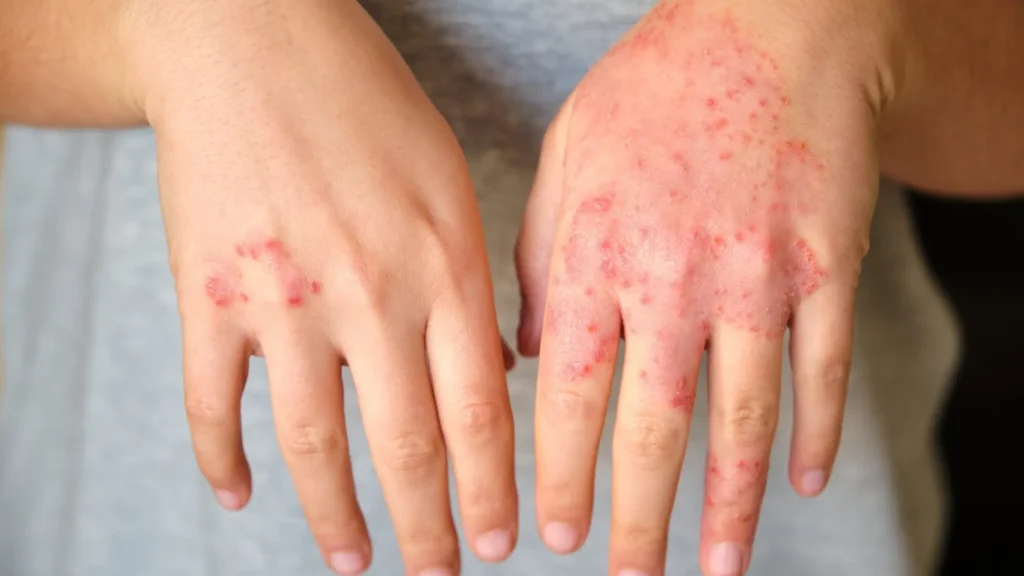 Eczema