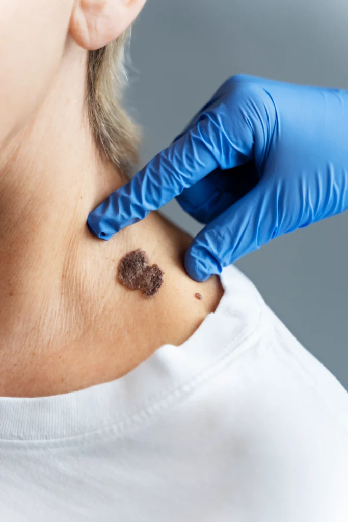 melanoma