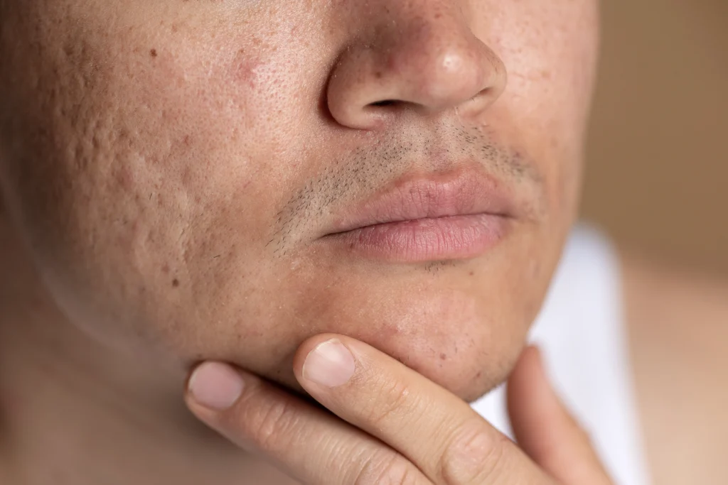 Acne Scarring