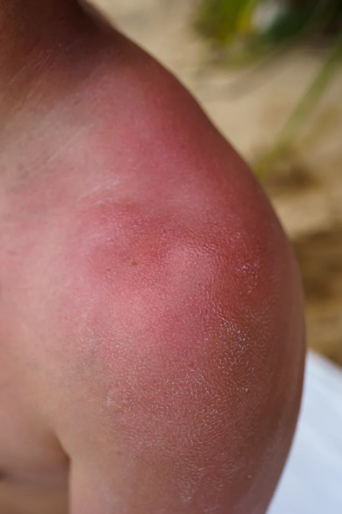 sunburn